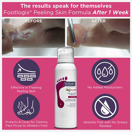 Footlogix Peeling Skin Formula Mousse (7) 4.23 oz.  20131